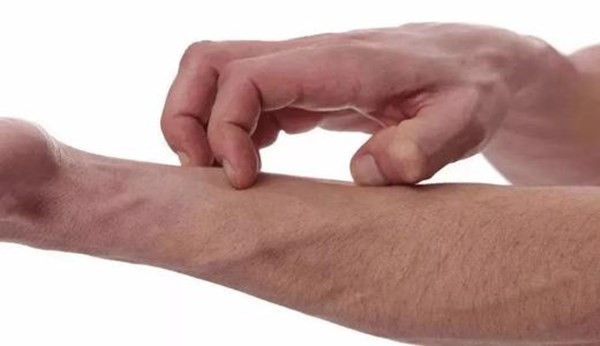 湿疹快速止痒的方法？