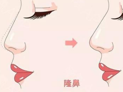 海口鼻综合多少钱