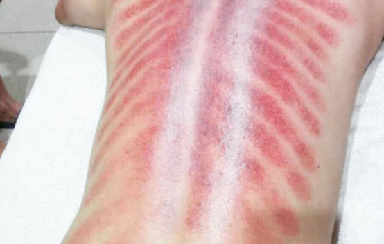 刮痧可以减肥吗