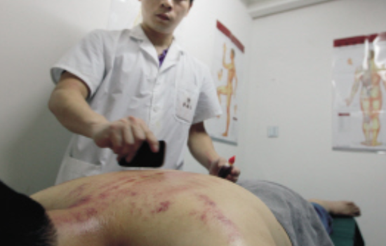 刮痧可以减肥吗