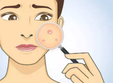 福建宁德一男子反复挤痘后出血不止引发血管瘤,血管瘤是一种什么疾病?