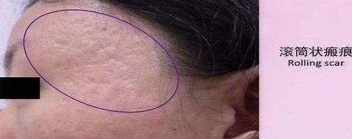 脸上很多痘坑,该怎么办?