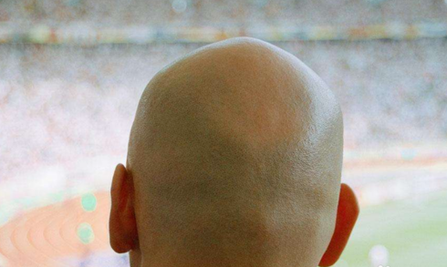 头上长虱子了,用什么简单的小方法可以快速去除呢?