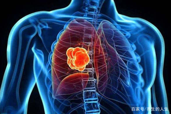 肺癌的早期症状和前兆,你知道的都有哪些?