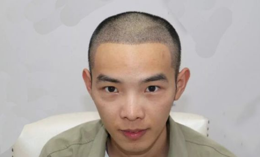 植发贵吗，大概得多少钱呢