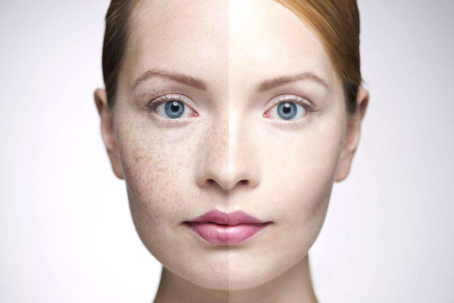 黄褐斑有哪些特点?