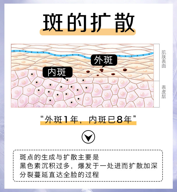 黄褐斑有哪些特点?