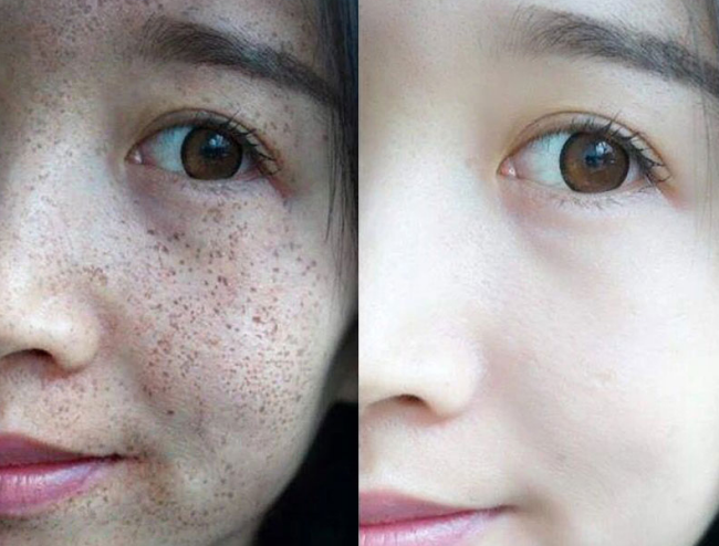 黄褐斑有哪些特点?