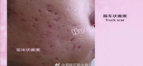 脸上很多痘坑,该怎么办?