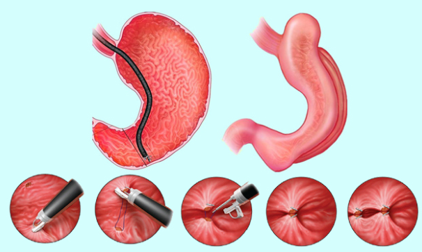 缩胃手术是干嘛的?