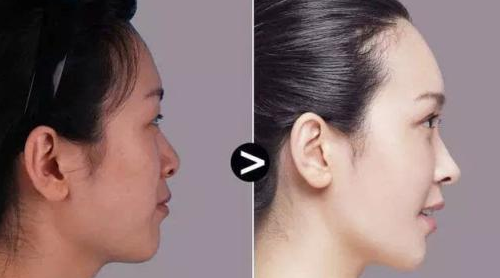 埋线提升是什么意思,埋线好不好,埋线能维持多久