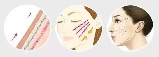 埋线提升是什么意思,埋线好不好,埋线能维持多久