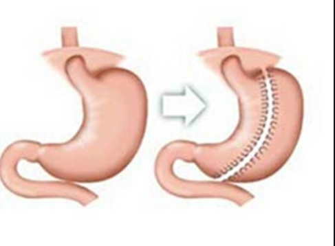 缩胃手术是干嘛的?