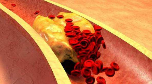 中国心血管病患者达3.3亿,哪些不良习惯会导致心血管病的发生?