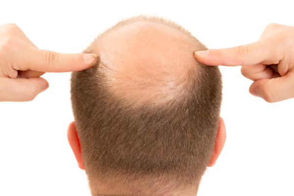 年轻人为什么开始严重脱发呢？