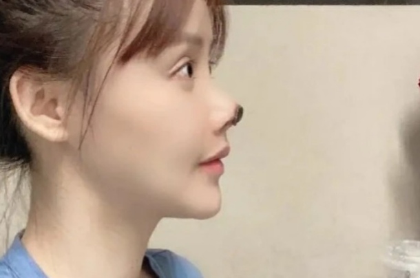 女星整容失败鼻头坏死，损失240万欲轻生，门诊是否需要承担责任？