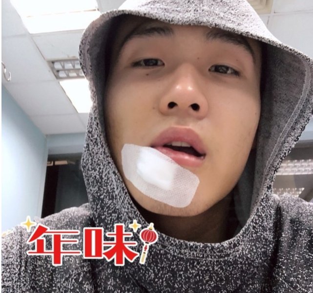 赵睿过年受伤破相严重吗？