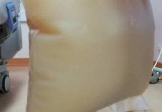 体内抽出牛奶血是怎么回事？