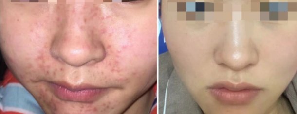 脸上长痘痘怎么快速消