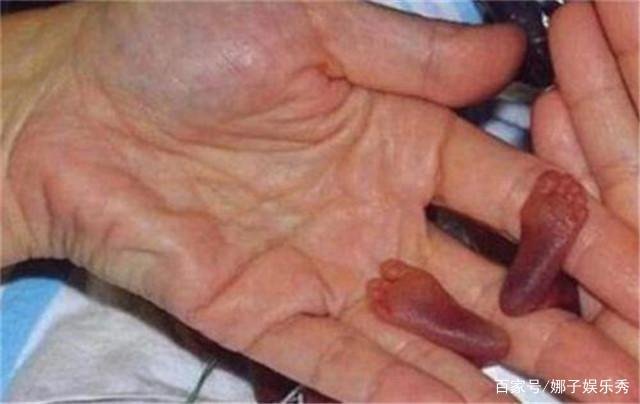 现实版拇指姑娘，出生时只有25厘米打破世界纪录，现状如何？