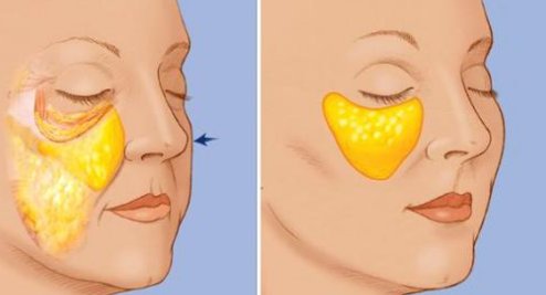 面部悬吊除皱手术能维持多久
