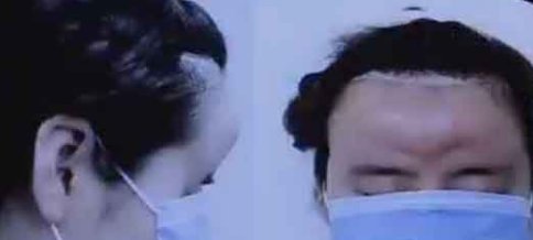 面部悬吊除皱手术能维持多久