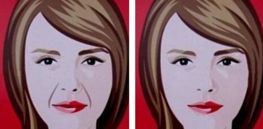 面部悬吊除皱手术能维持多久