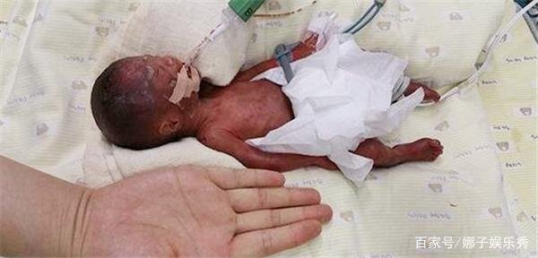 现实版拇指姑娘，出生时只有25厘米打破世界纪录，现状如何？