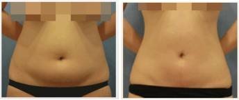 腰腹吸脂几天能看到效果？