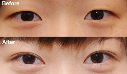 开眼角的优点有哪些