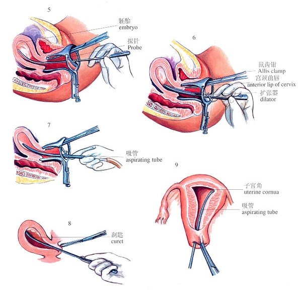 刮宫的适合时间