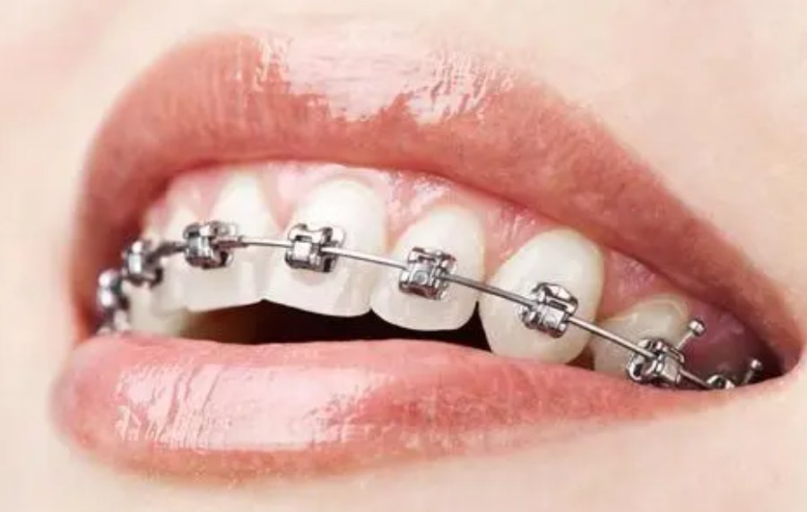 矫正牙齿一般需要多少费用?
