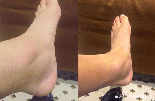 脚踝浮肿是什么原因引起的?如何消肿?