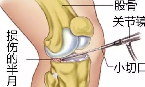 半月板损伤的最好治疗方法