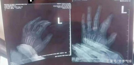 女童店内玩耍被砸骨折，家属直接索赔50万，对此你如何看待？