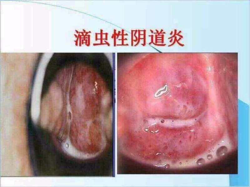 泡沫性白带，豆腐渣白带，水性白带都是什么样子的?要图片