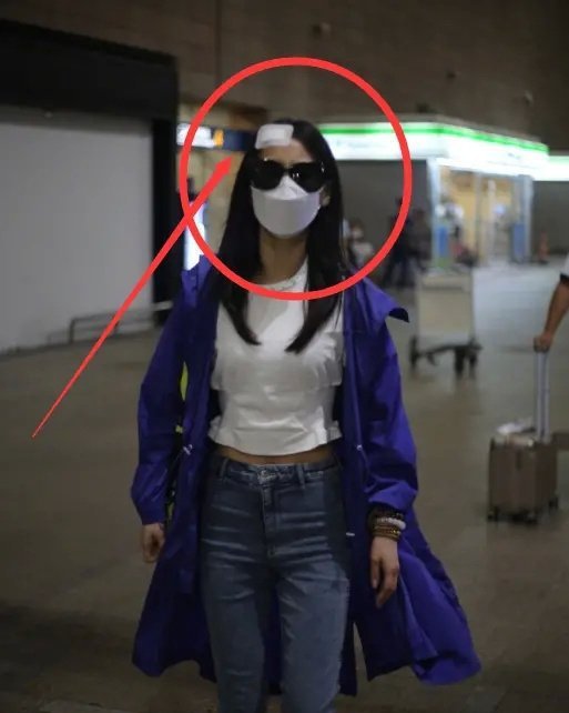 黄圣依拍戏时头部受伤,受伤情况如何,严重吗?