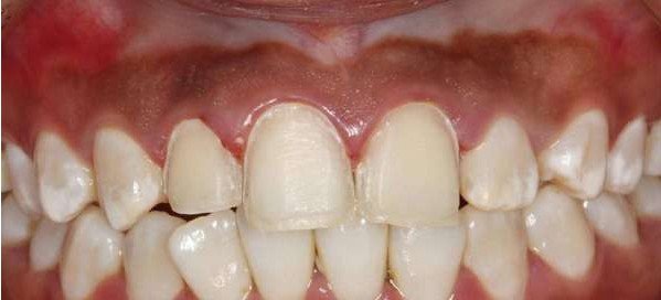 镍铬烤瓷牙的利弊关系