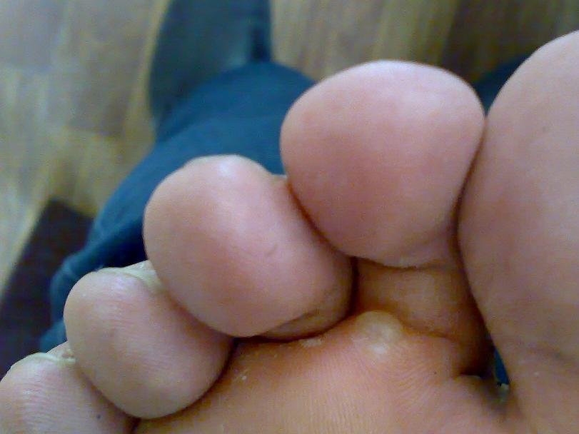 治脚气最好的办法是什么?