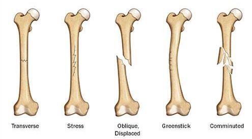 骨折后常见的后遗症有哪些?需要怎样调理?