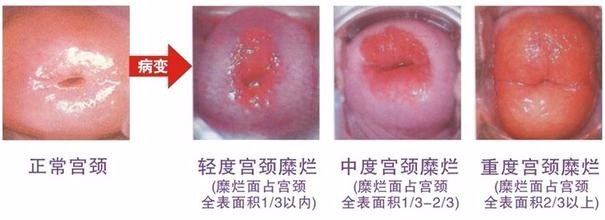 宫颈糜烂症状图片是什么样的
