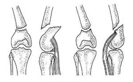骨折后常见的后遗症有哪些?需要怎样调理?