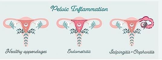 流产后肚子疼怎么回事?