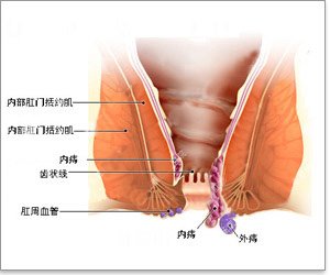 外痔疮的最佳治疗方法是什么？