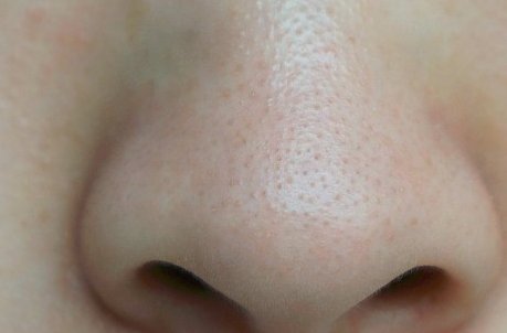 为什么鼻子上会有很多黑头呢?