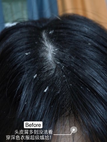 头皮屑非常多是为什么？