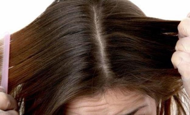 头皮屑一块一块的，但是不痒是怎么回事？