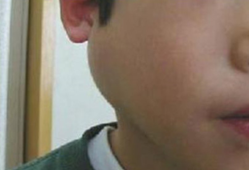 流行性腮腺炎如何有效预防？