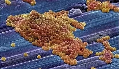 非常古老但依然强大,马王堆曾发现中国最早结核菌,结核菌感染有何症状?