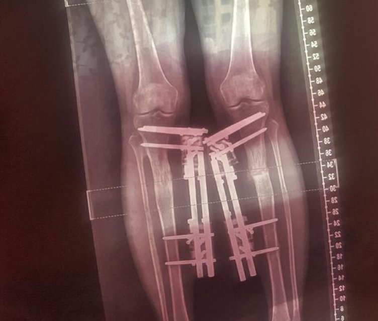 淮安小伙断骨增高失败致终身残疾，断骨增高有成功的案例吗？